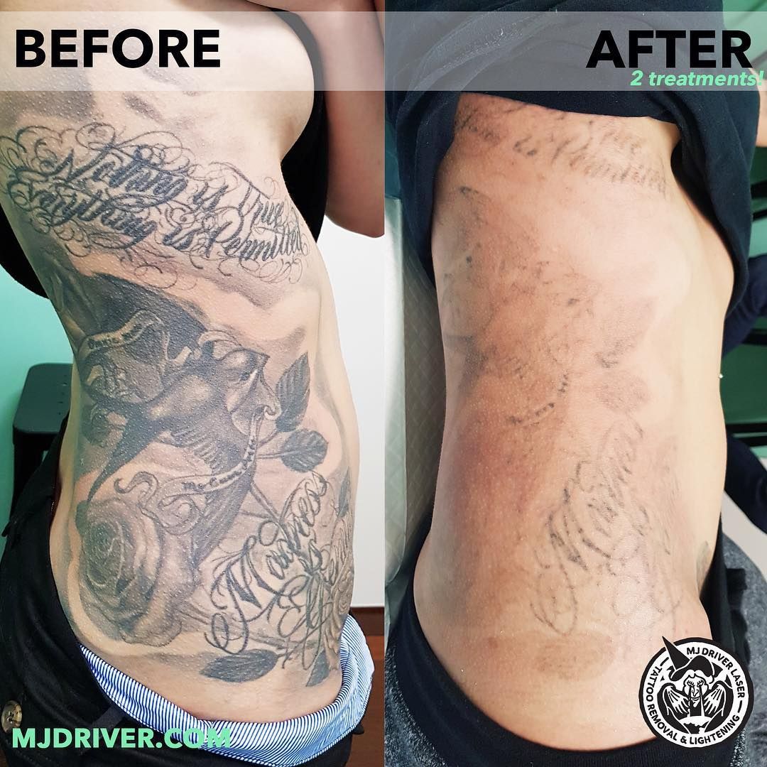 Laser Tattoo Removal Before And After 5 Sessions