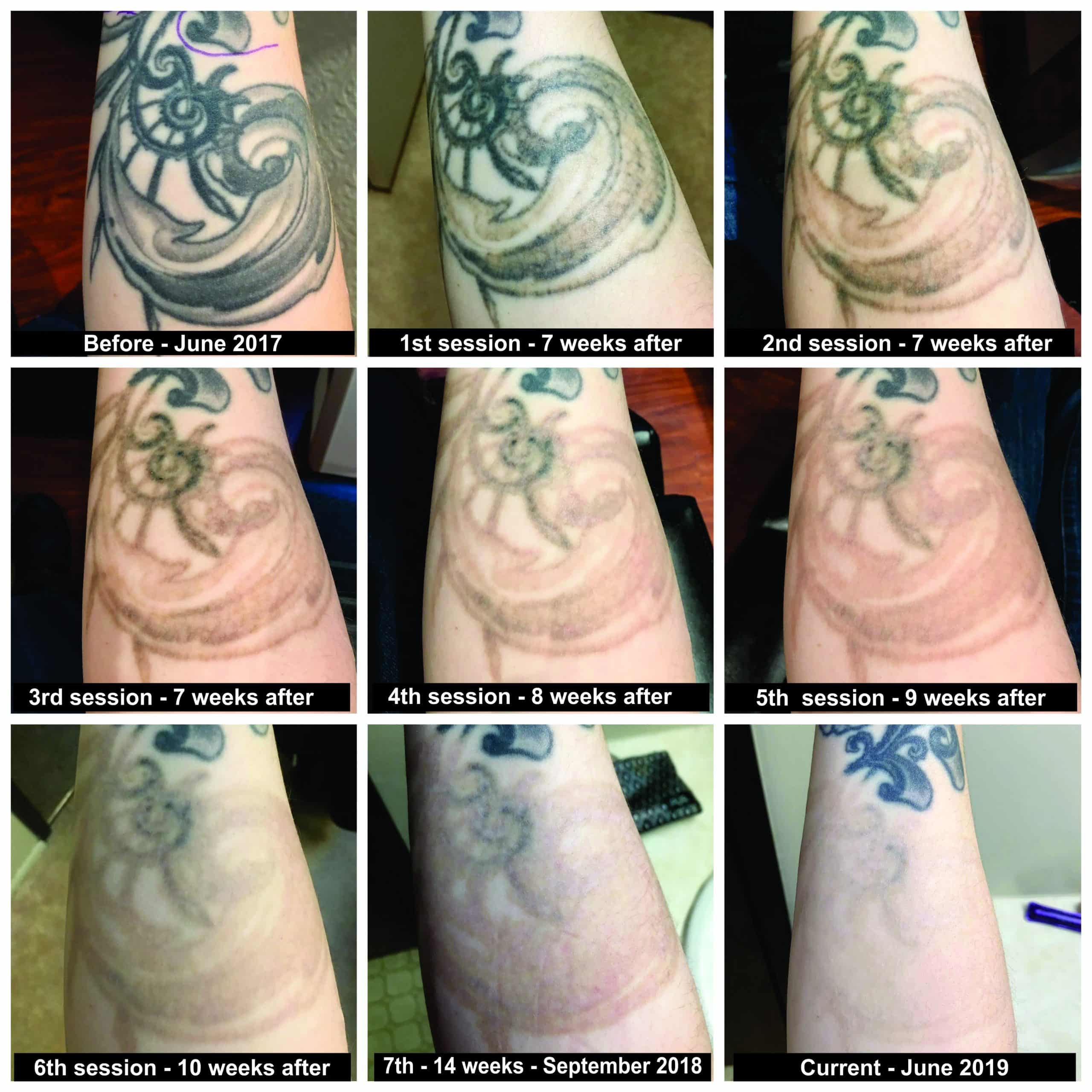 Laser Tattoo Removal Before And After First Session