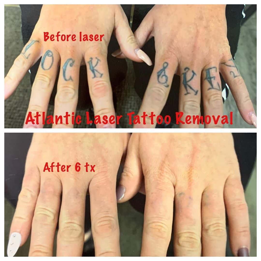 Laser Tattoo Removal Before And After Hand