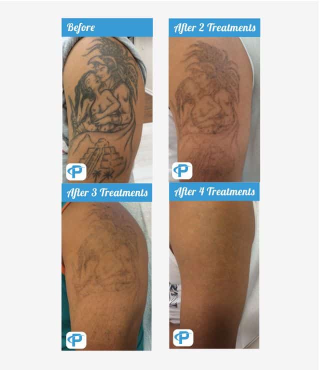 Laser Tattoo Removal Before and After Photos Premium Tattoo Removal
