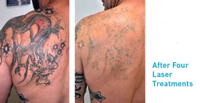 Laser Tattoo Removal Before and After update