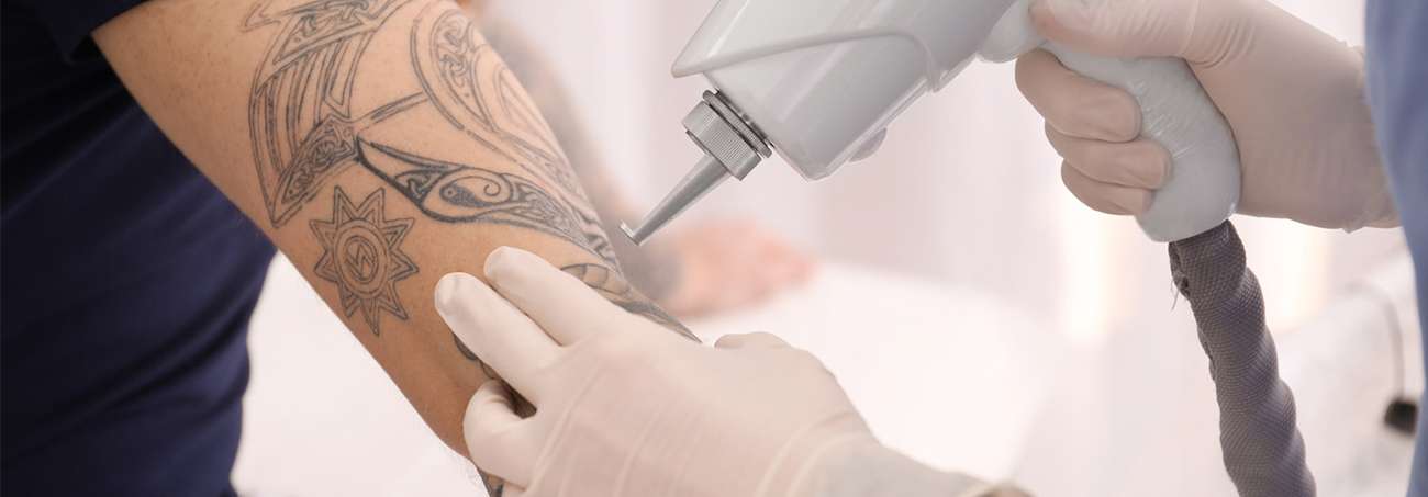 Laser Tattoo Removal Brisbane