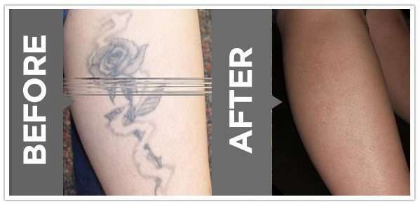Laser Tattoo Removal Cincinnati
