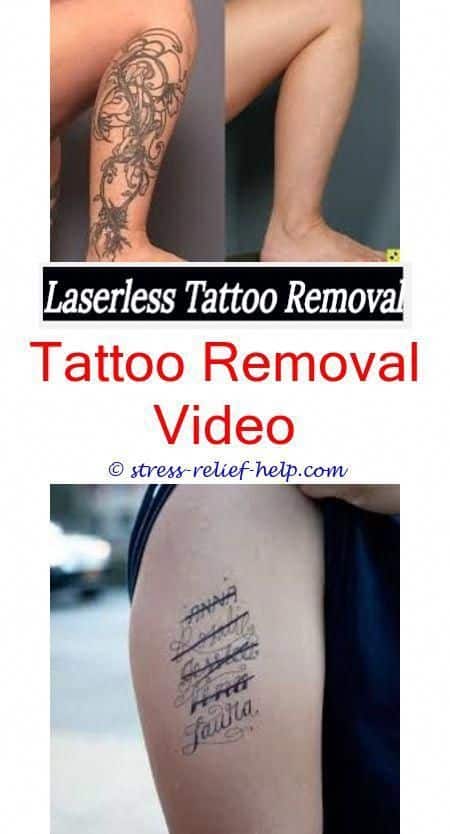 Laser Tattoo Removal Cost Baton Rouge