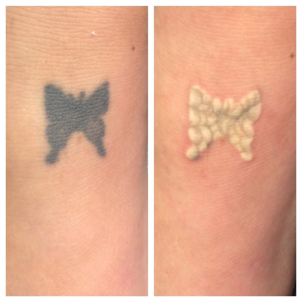 Laser Tattoo Removal Cost in Albany, NY