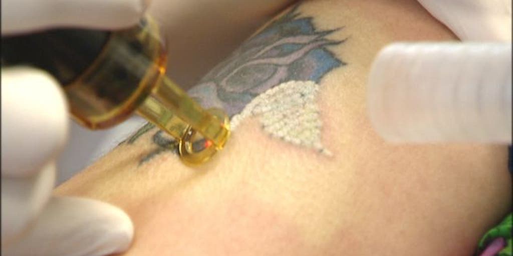Laser Tattoo Removal Cost Nyc