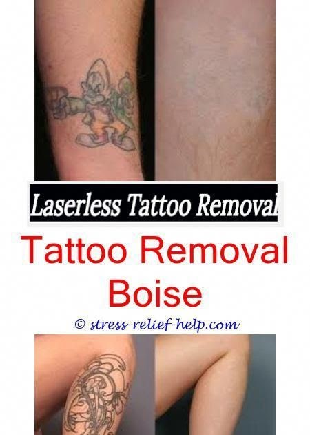 Laser Tattoo Removal Cost Small Tattoo
