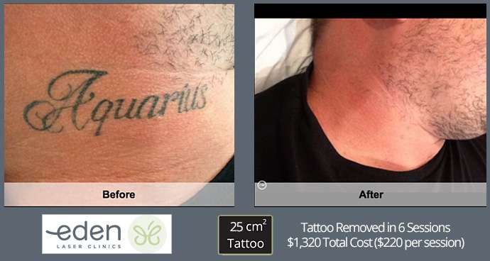 Laser Tattoo Removal Cost Sydney