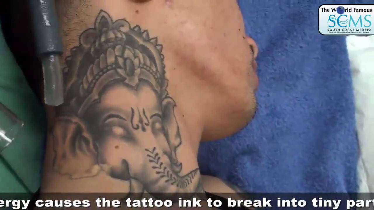 LASER TATTOO REMOVAL COST