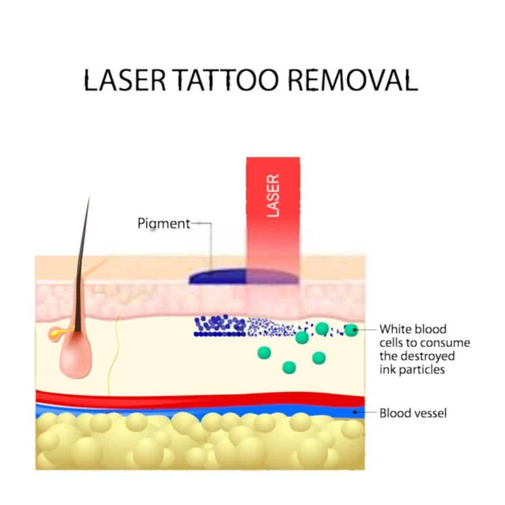 Laser Tattoo Removal  Derma Pro Skin &  Aesthetic Clinic