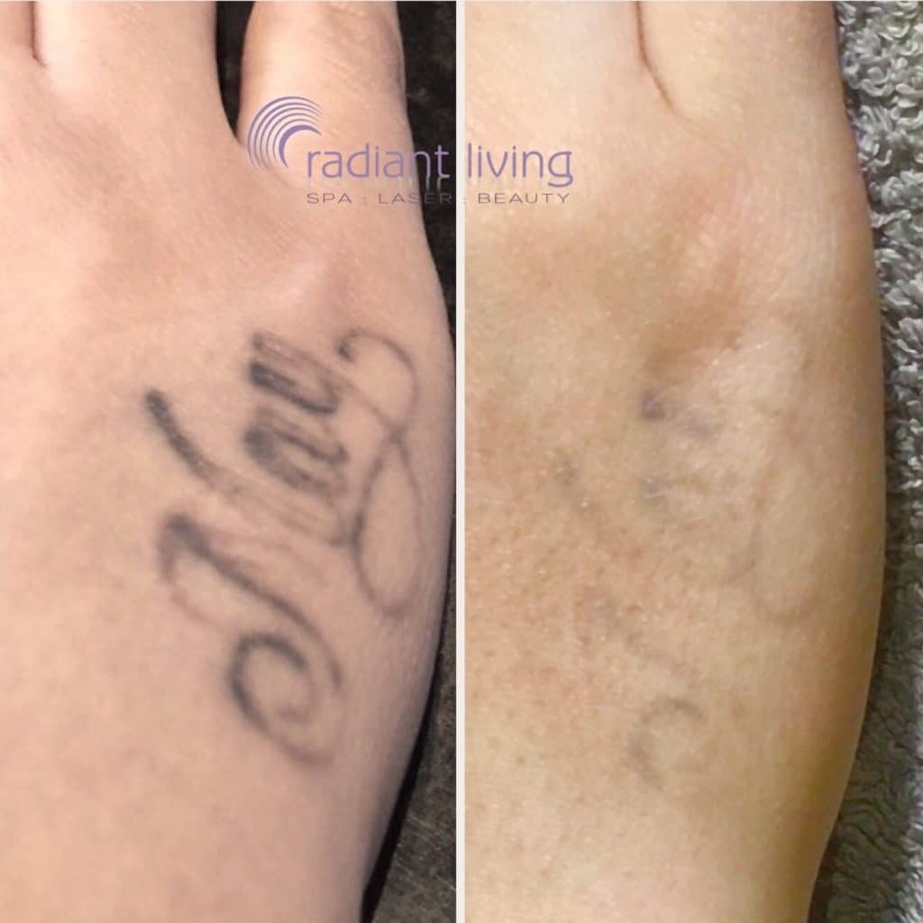 Laser Tattoo Removal experts with 15 years experience