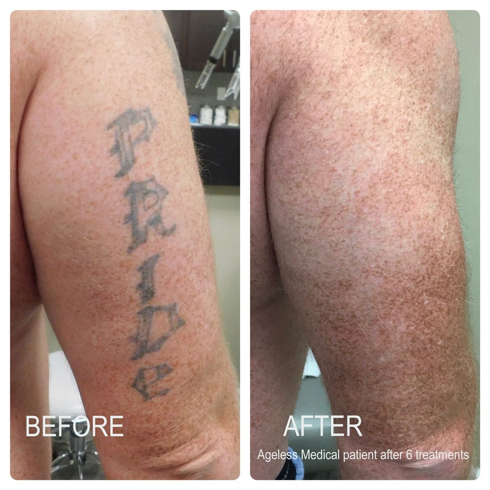 Laser Tattoo Removal Fort Lauderdale