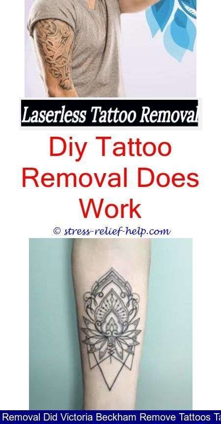 Laser Tattoo Removal Half Sleeve Cost