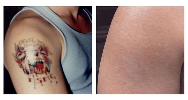 Laser Tattoo Removal Houston