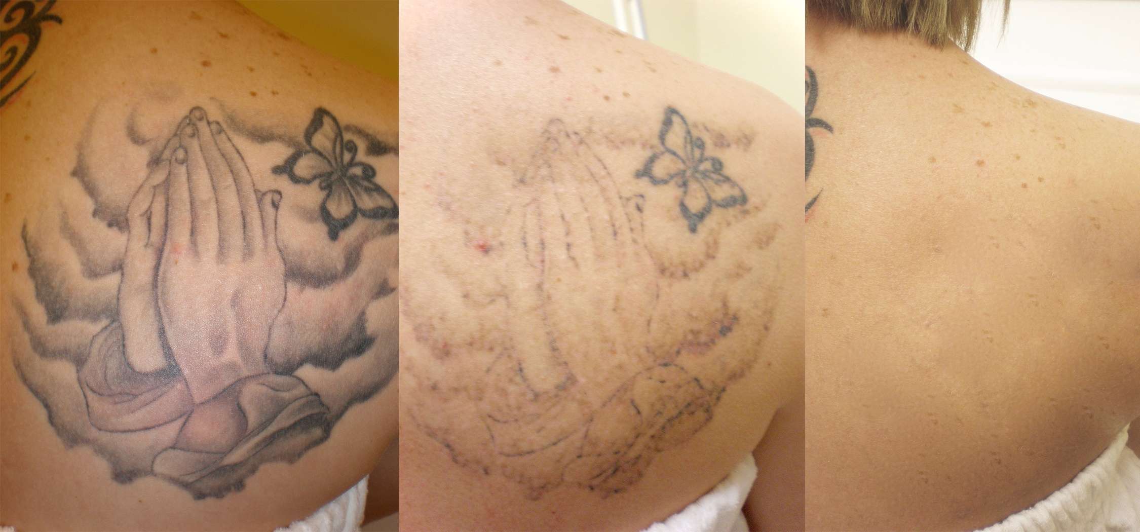 Laser Tattoo Removal in Calgary