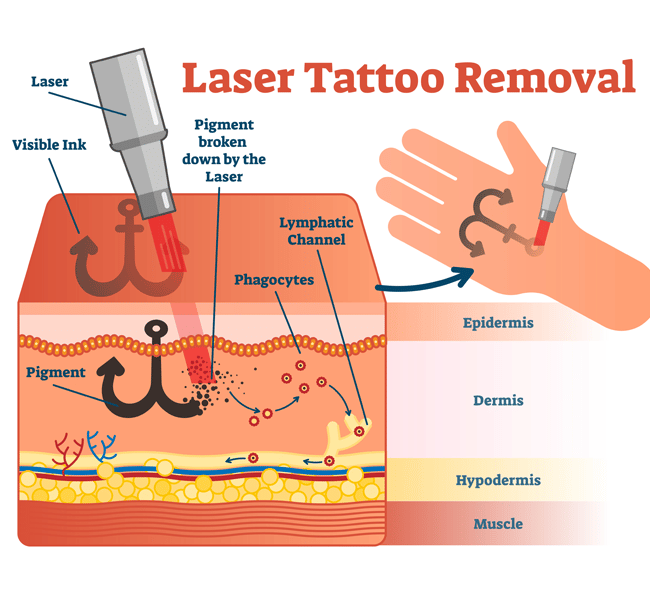 Laser Tattoo Removal in Ludhiana