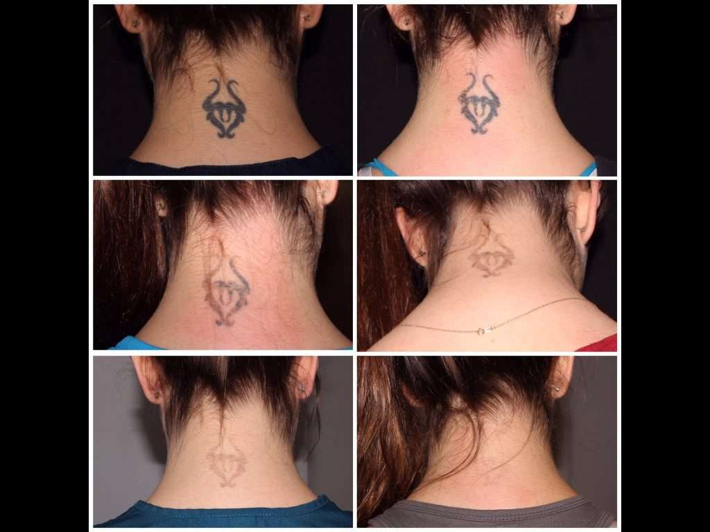 Laser Tattoo Removal in New York City