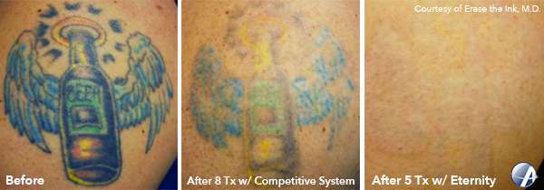 Laser Tattoo Removal in San Diego, California
