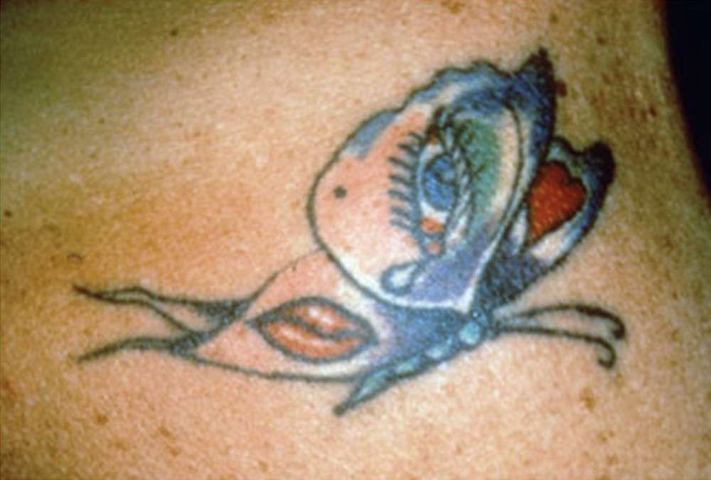 Laser Tattoo Removal in Saratoga Springs
