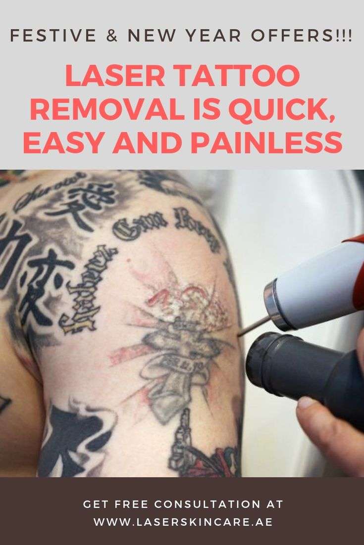 #Laser #Tattoo #Removal Is Quick, Easy and #Painless # ...
