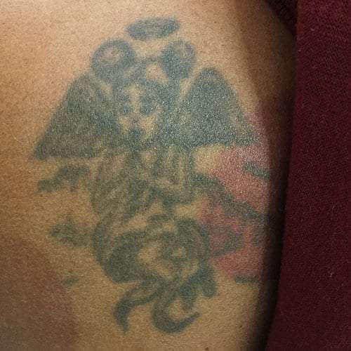 Laser Tattoo Removal Kansas City, MO