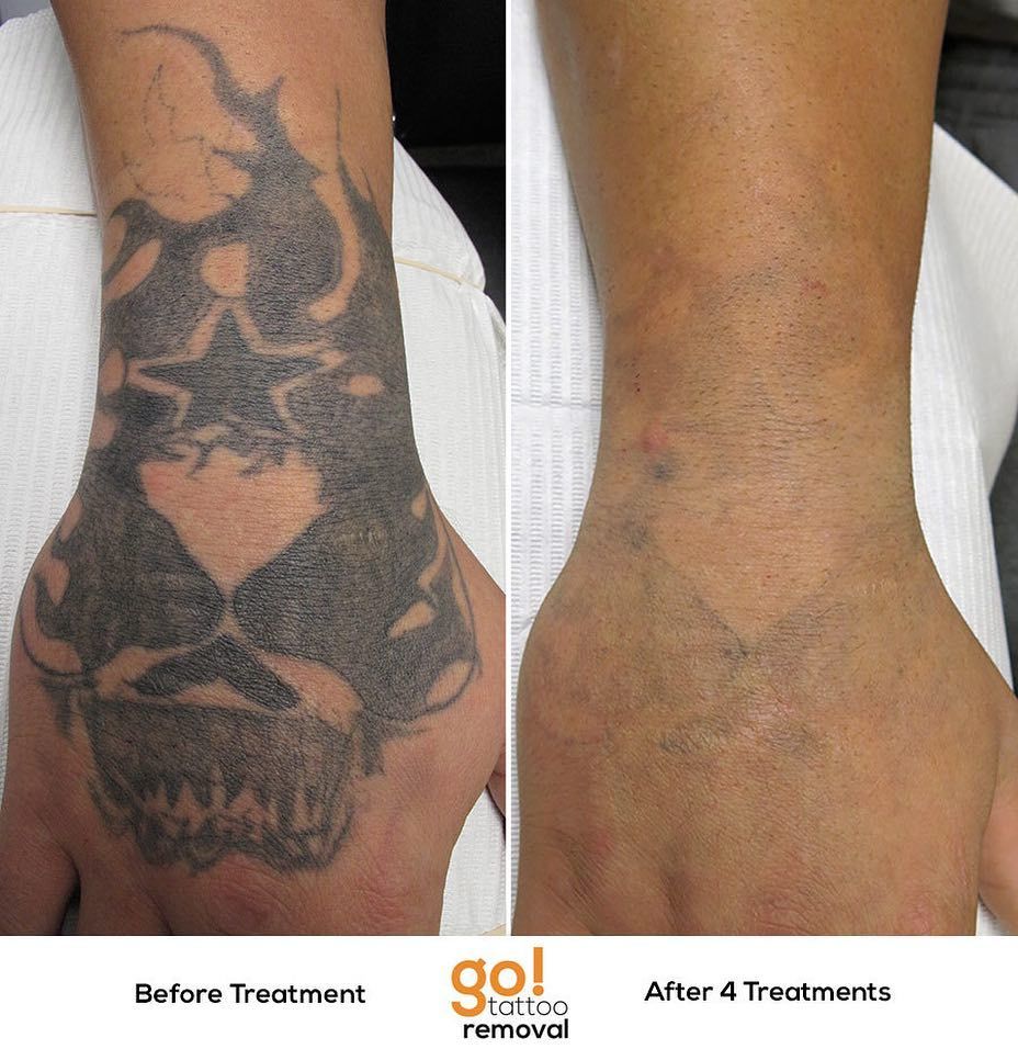 Laser Tattoo Removal Leave Scars