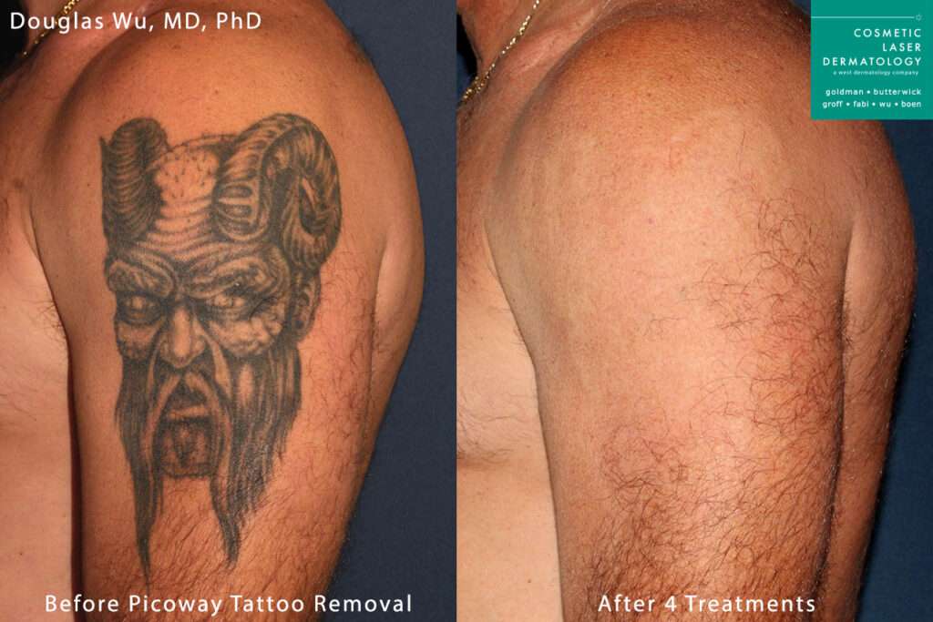 Laser Tattoo Removal Medical Spa