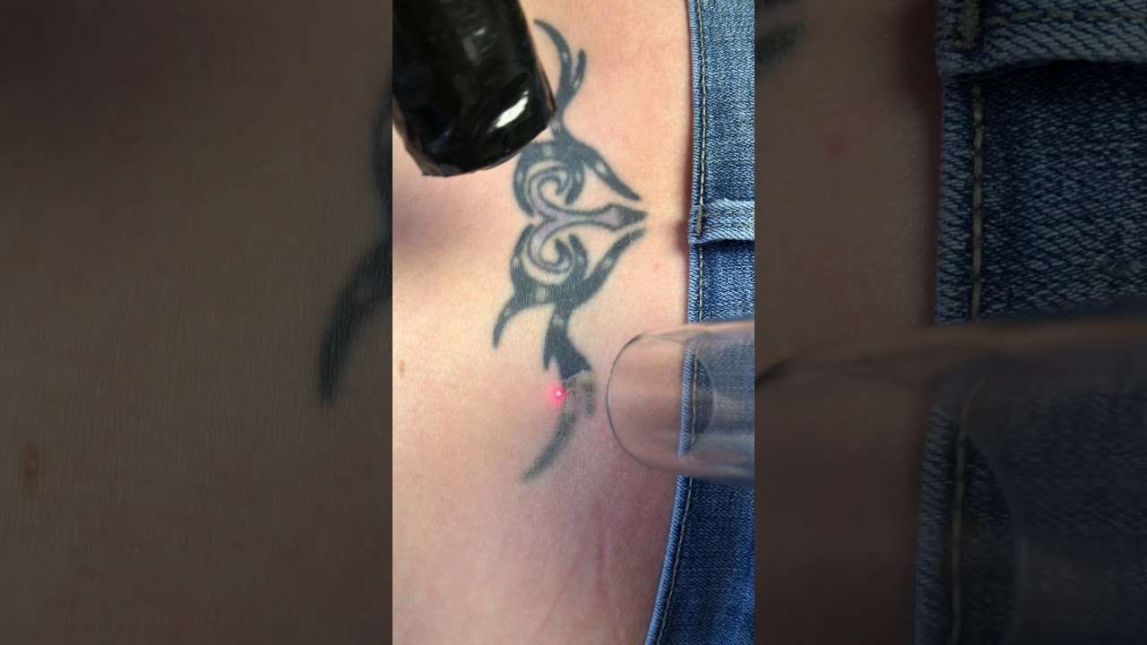 Laser tattoo removal on a lower back tattoo on a female in ...