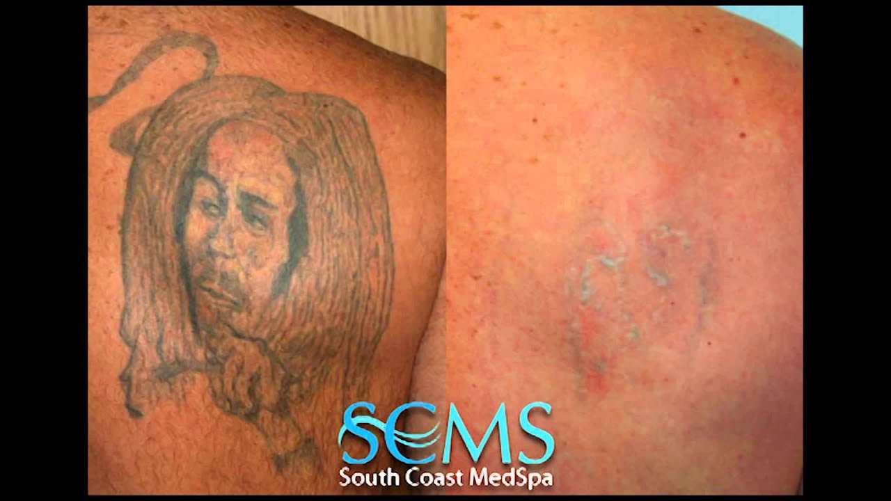 Laser Tattoo Removal Orange County Before/After