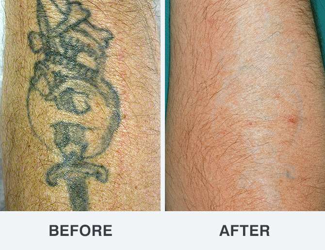 Laser Tattoo Removal Photos