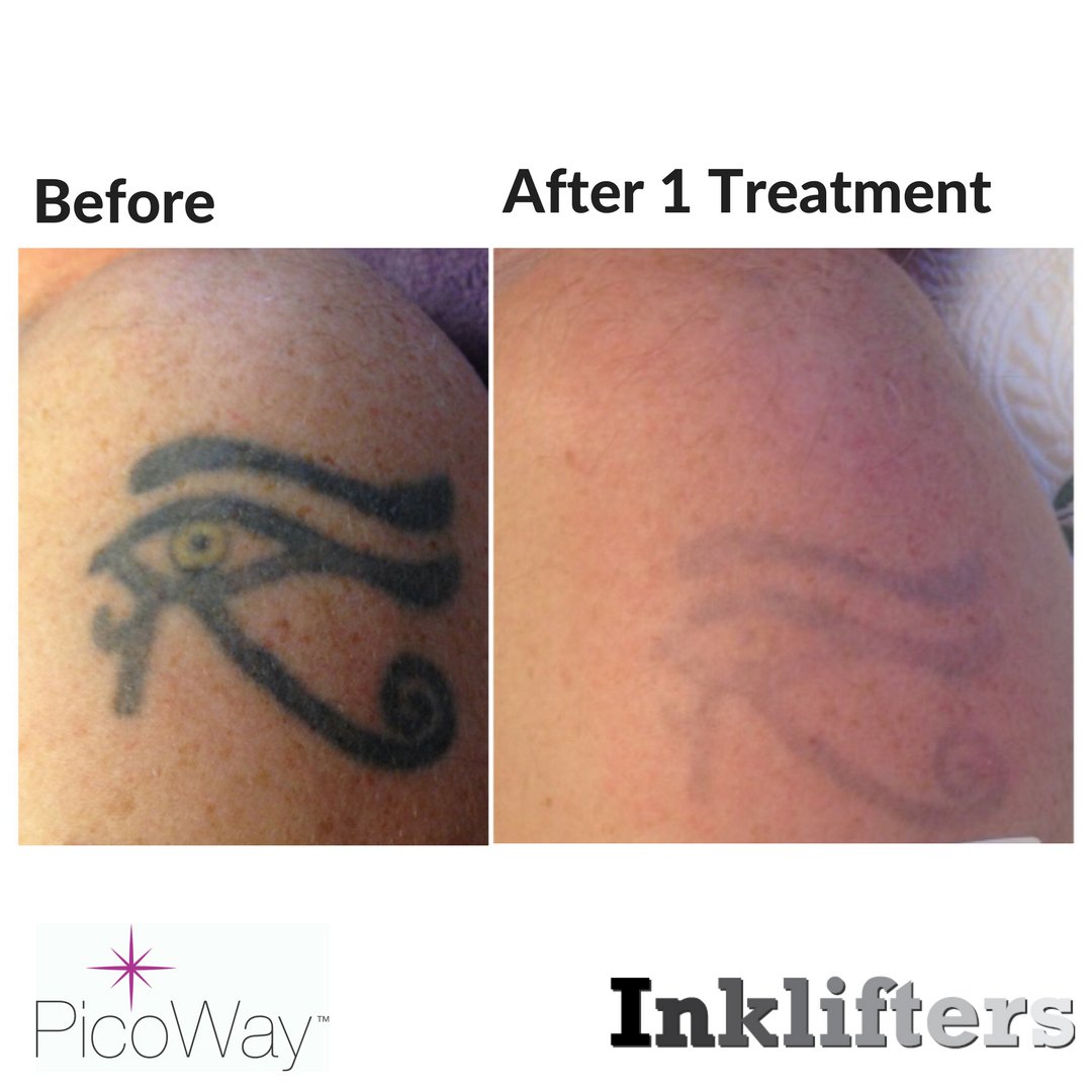 Laser Tattoo Removal Pictures After 1 Treatment