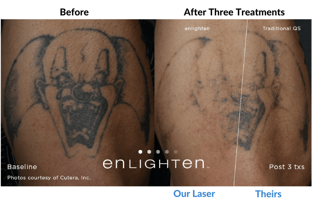 Laser Tattoo Removal Portland