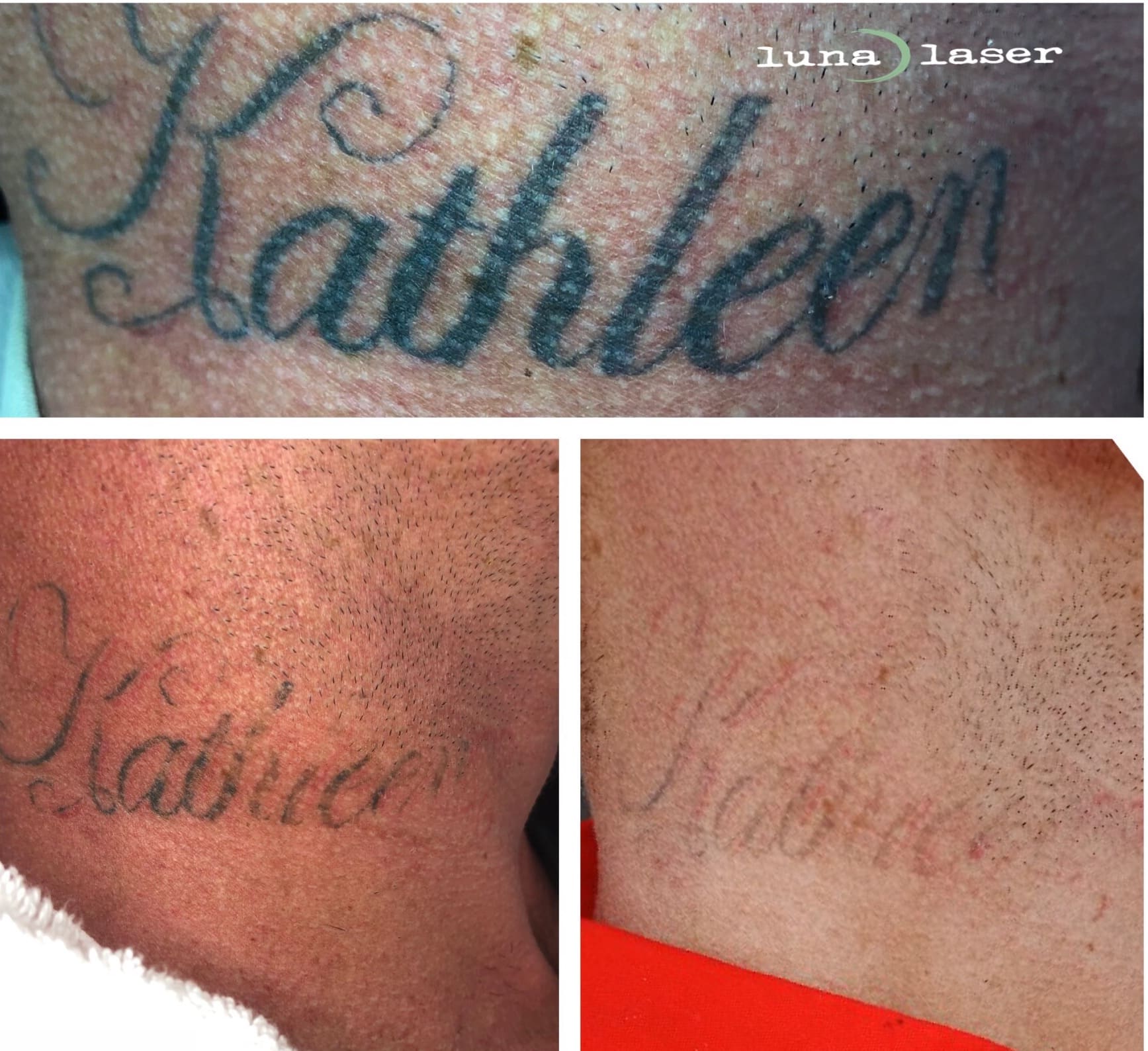 Laser Tattoo Removal Process, Cost &  Price