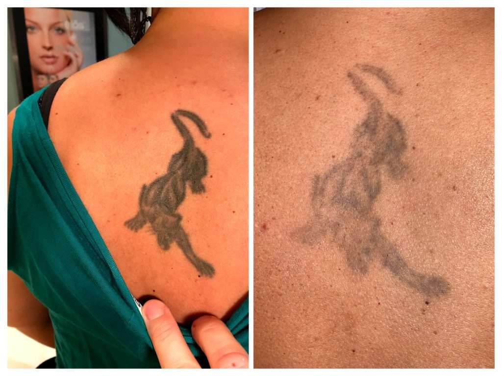 Laser Tattoo Removal Pros in Allentown &  Easton l Rated #1