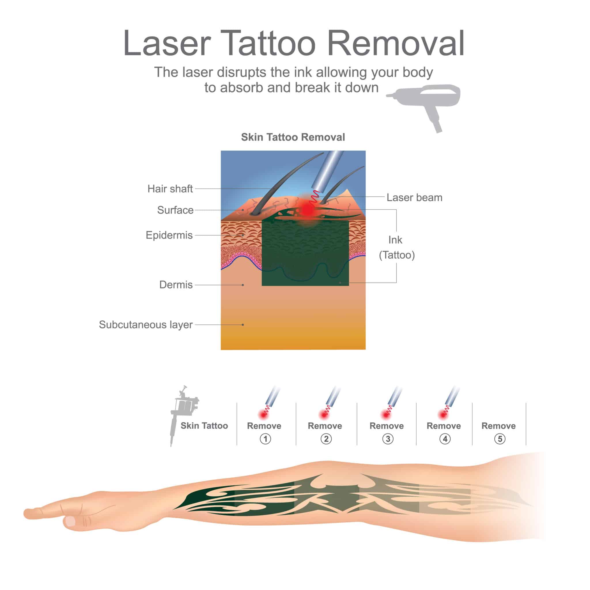 Laser Tattoo Removal  Queen Street Aesthetic
