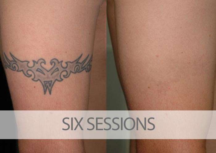 Laser Tattoo Removal Results Gallery