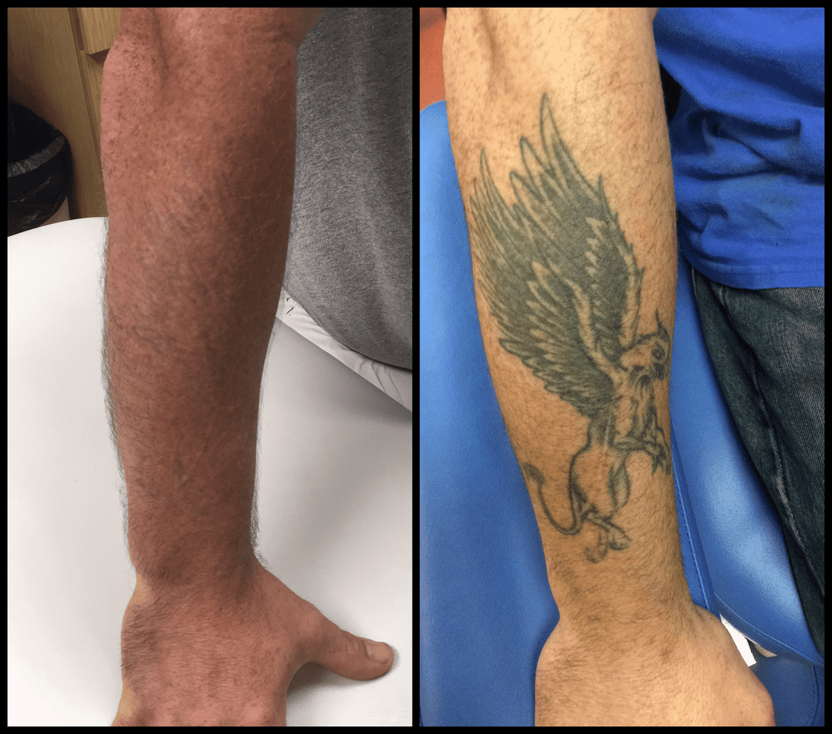Laser Tattoo Removal Richmond Va / Faq Richmond Mechanicsville Va East ...