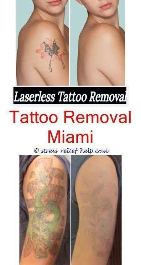 Laser Tattoo Removal Scars