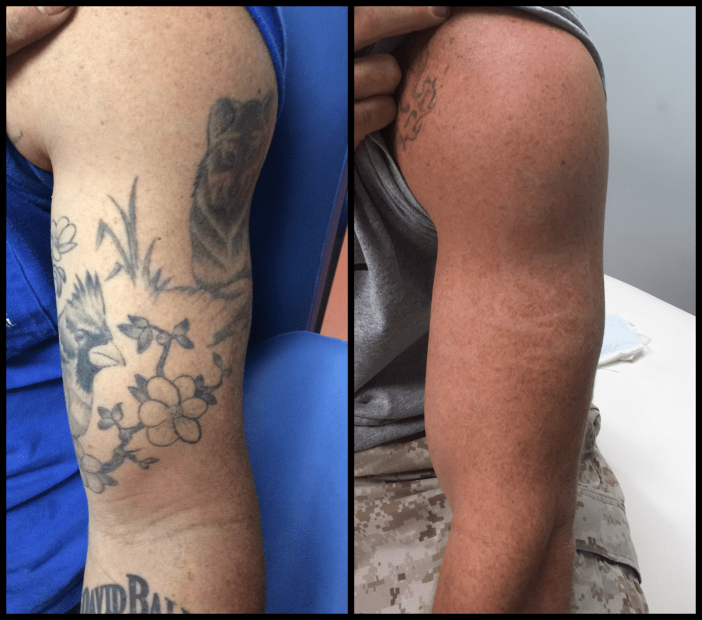 Laser Tattoo Removal Scars Pictures
