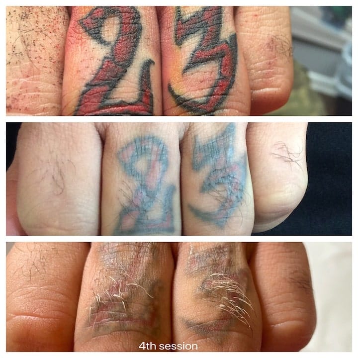 Laser Tattoo Removal Services in Fort Myers and Naples, FL