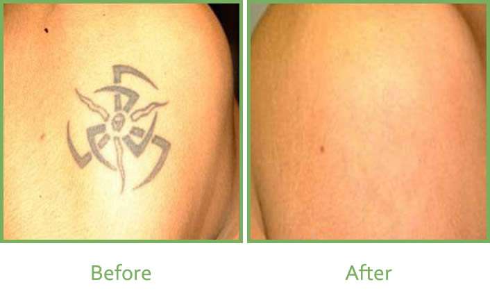 Laser Tattoo Removal Services In South Wales