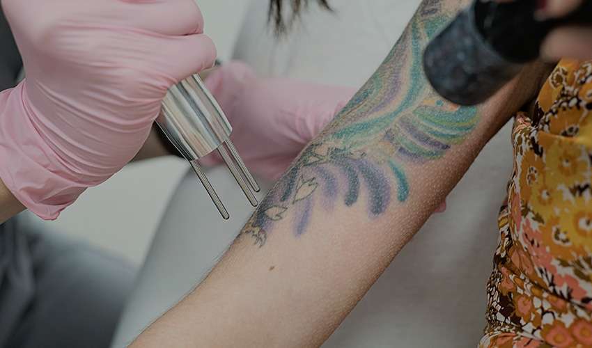 Laser Tattoo Removal Services