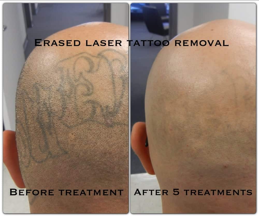 Laser Tattoo Removal Singapore Review