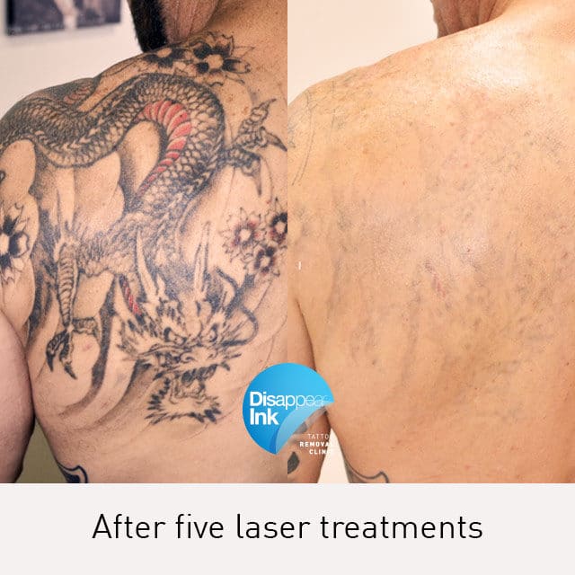 Laser Tattoo Removal Sydney