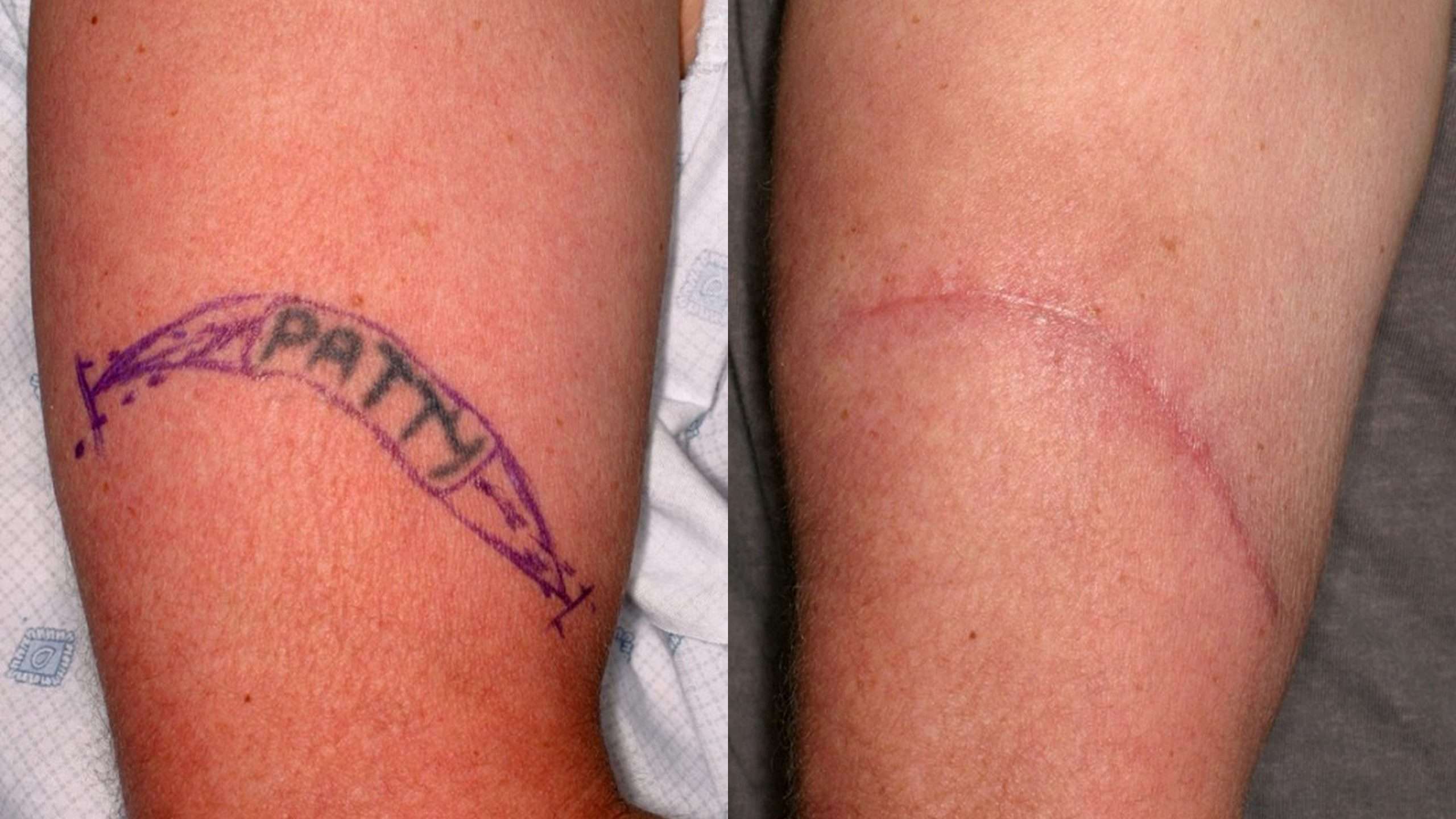 LASER Tattoo Removal Tattoo Surgery and other methods: All ...