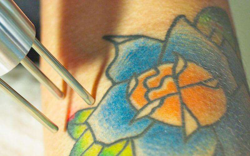 Laser Tattoo Removal Technology