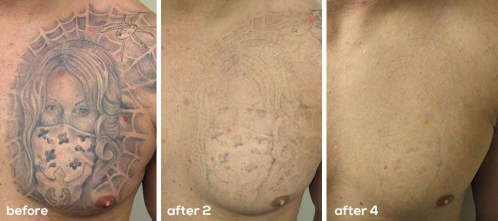 Laser Tattoo Removal: The Effective And Safe Way To Get ...