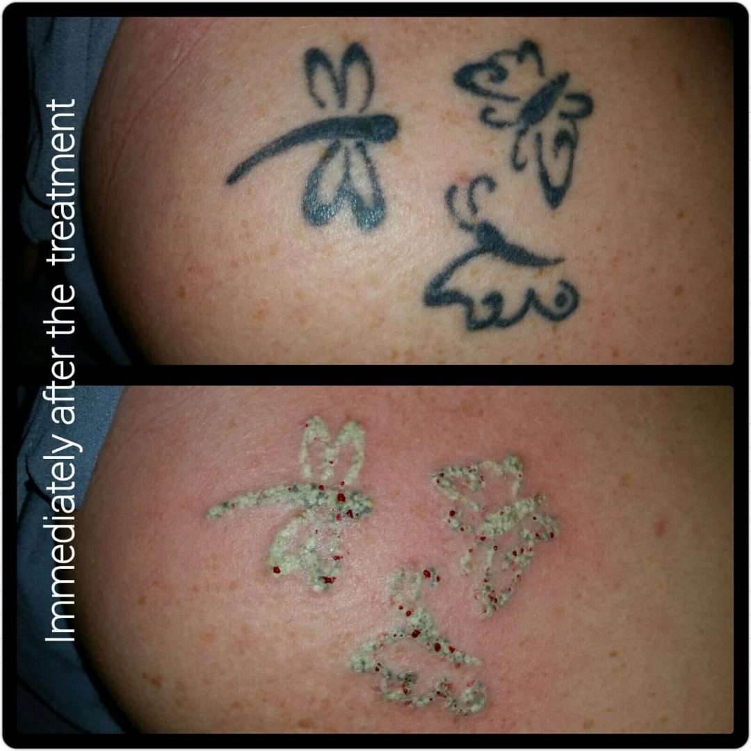 Laser Tattoo Removal Timeline / Does Laser Tattoo Removal Hurt?