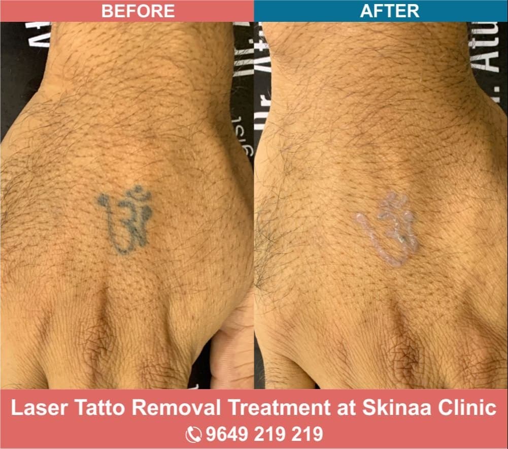 Laser Tattoo Removal Treatment at Rs 300/consultation
