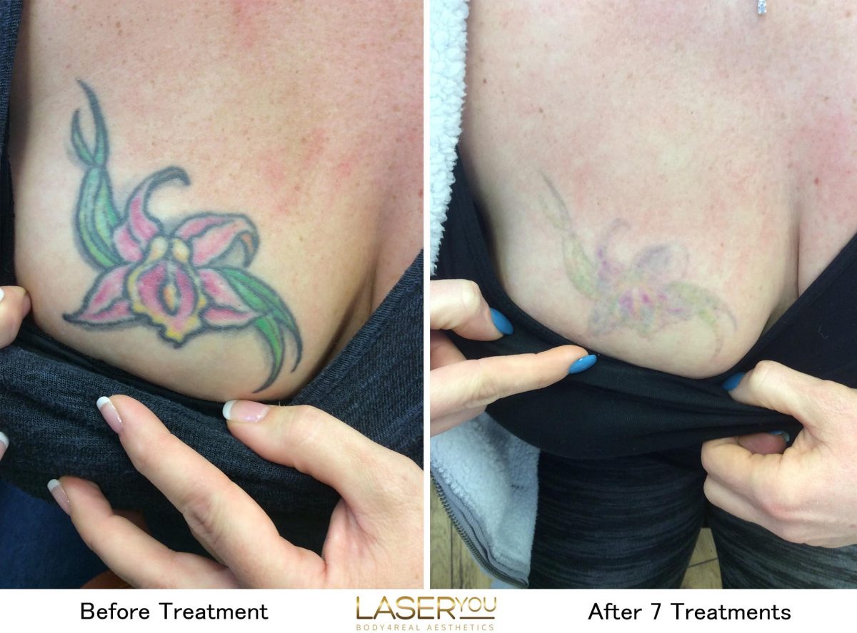 Laser Tattoo Removal Using PicoSure â LaserYou PicoSure Tattoo Removal ...